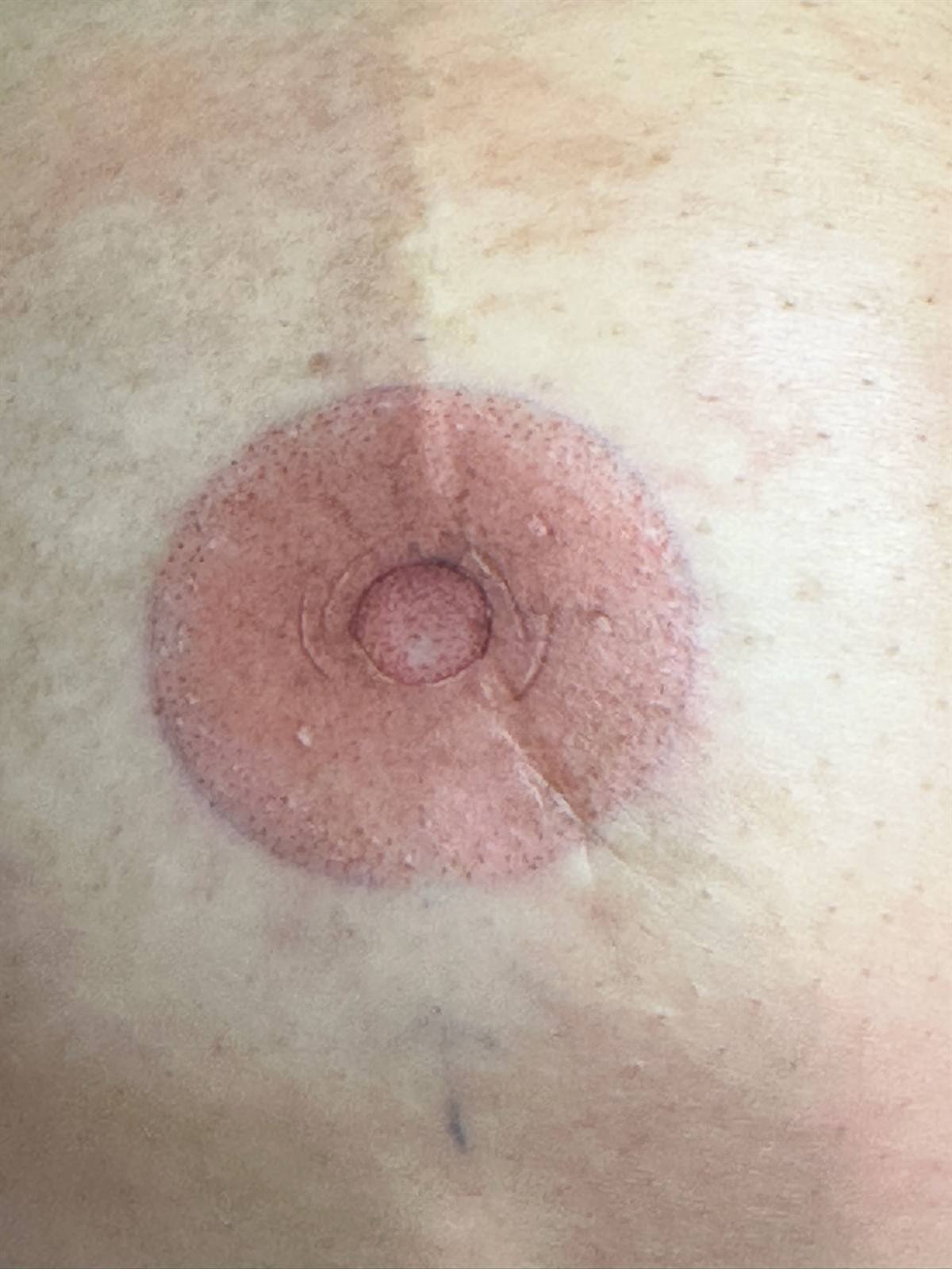 3D areola restoration close detail